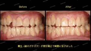 部分矯正による歯のガタガタ（叢生）治療のビフォーアフターBefore After